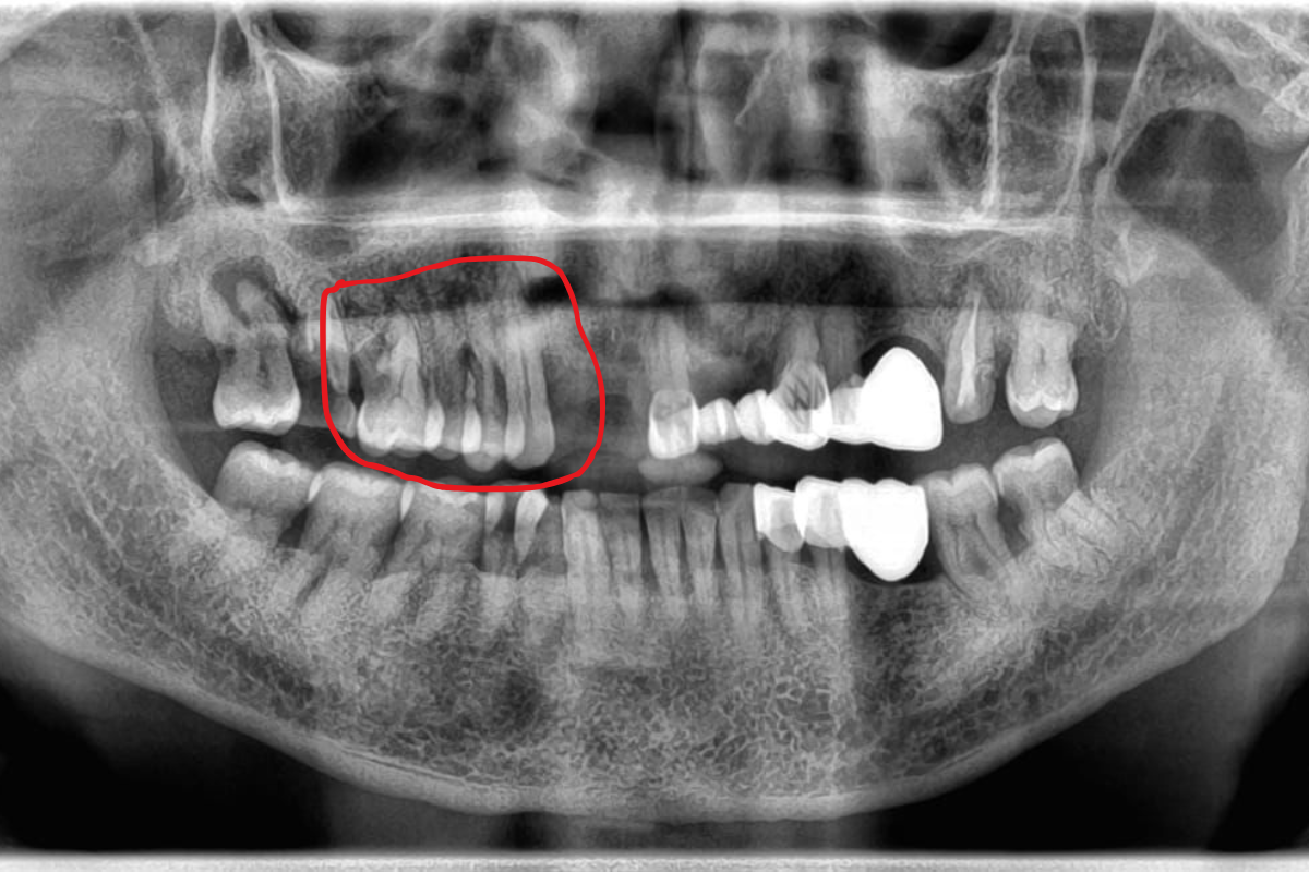 Before Treatment